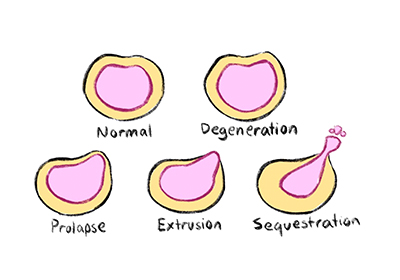 Disc Herniation Stages